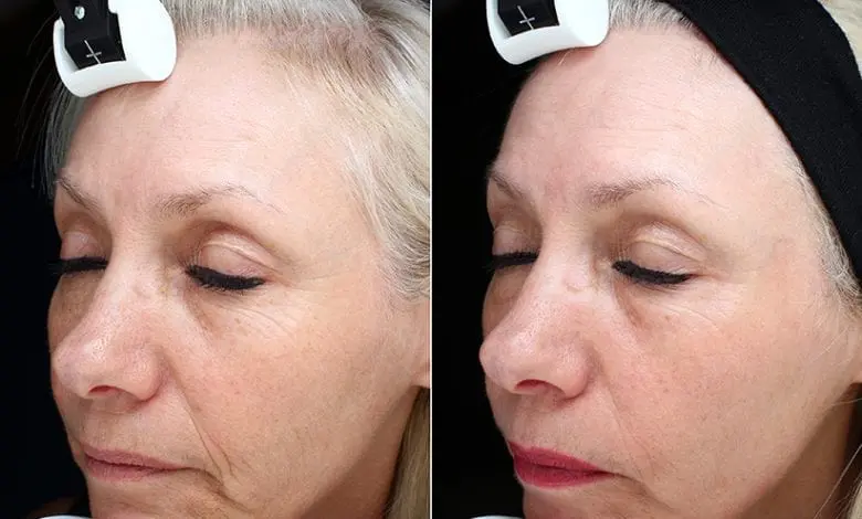 Mezoterapia laser – un nou concept de îngrijire a pielii, la THAIco SPA