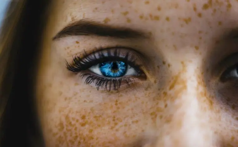 Melasma