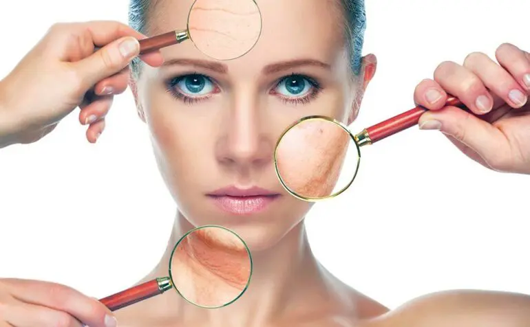 Melasma